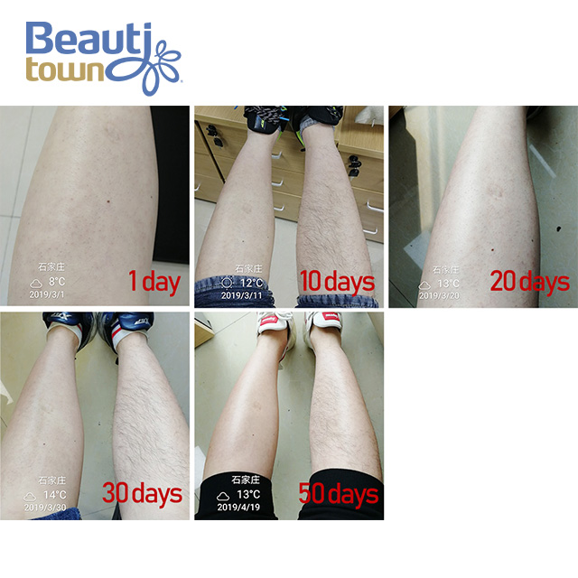 Best Laser Hair Removal Machine with Double Handle