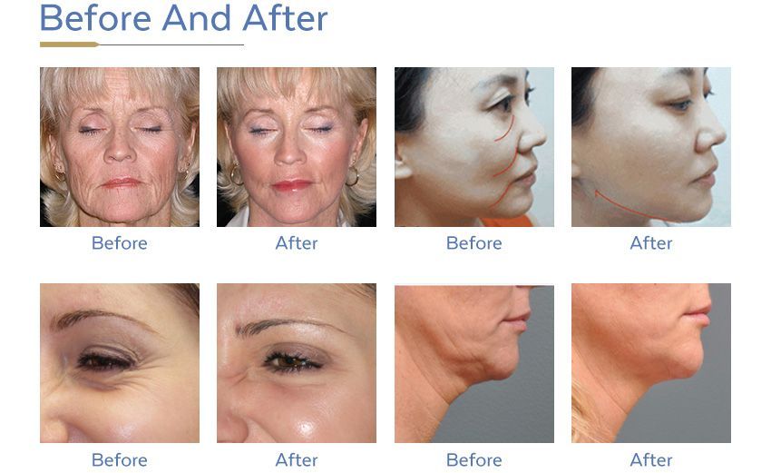 Portable Hifu Home Machine Skin Rejuvenation-FU4.5-9S